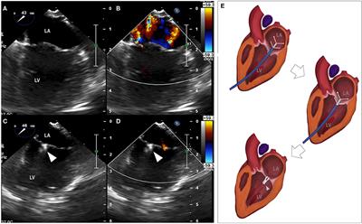 Preliminary Outcome of a Novel Edge-to-Edge Closure Device to Manage Mitral Regurgitation in Dogs